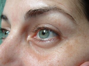 What Causes Dark Circles Around Your Eyes, and How We Treat Them With Dermal Fillers.