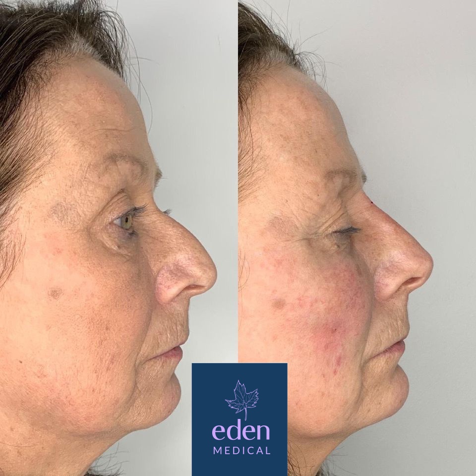 Nose filler before and after