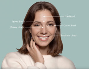 most common anti-wrinkle injection areas