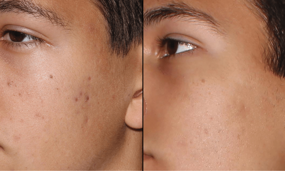 Forever-Clear-B&A (2)-min