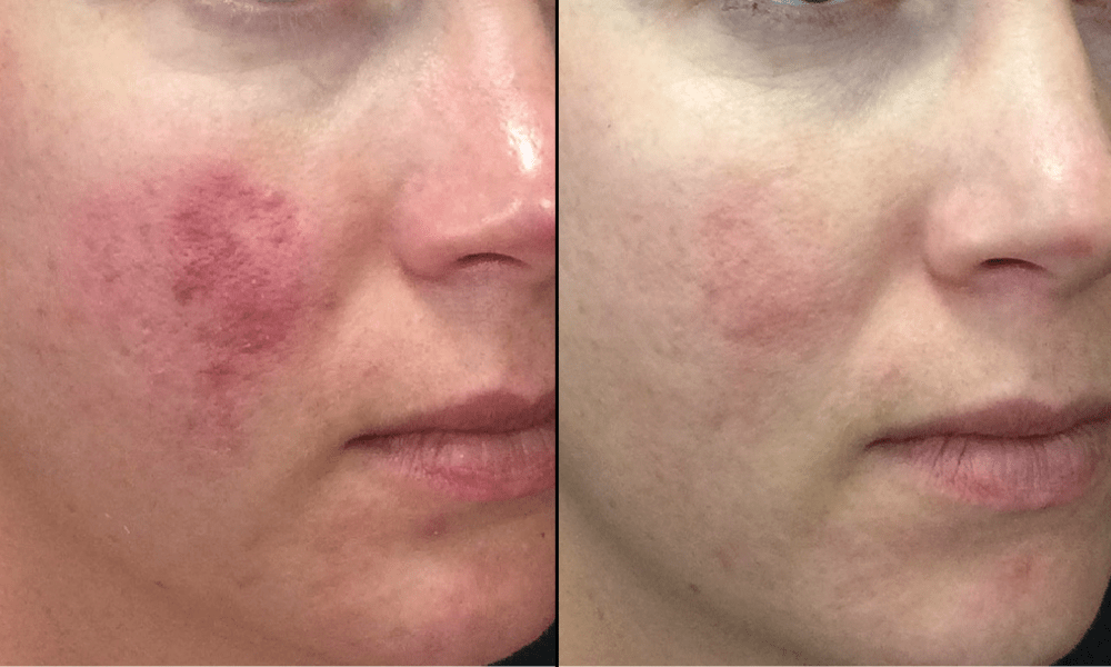 Forever-Clear-B&A (3)-min