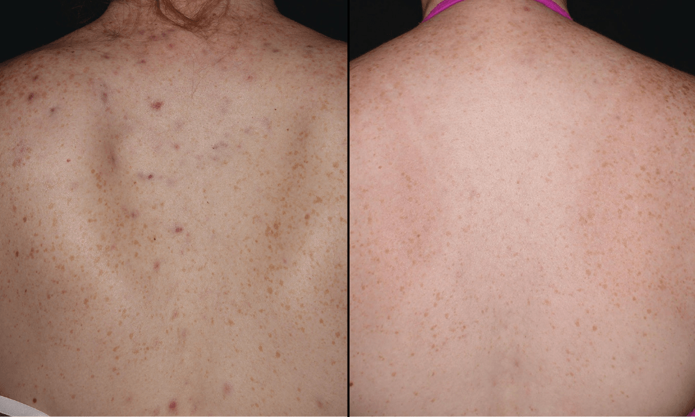 Forever-Clear-B&A (4)-min