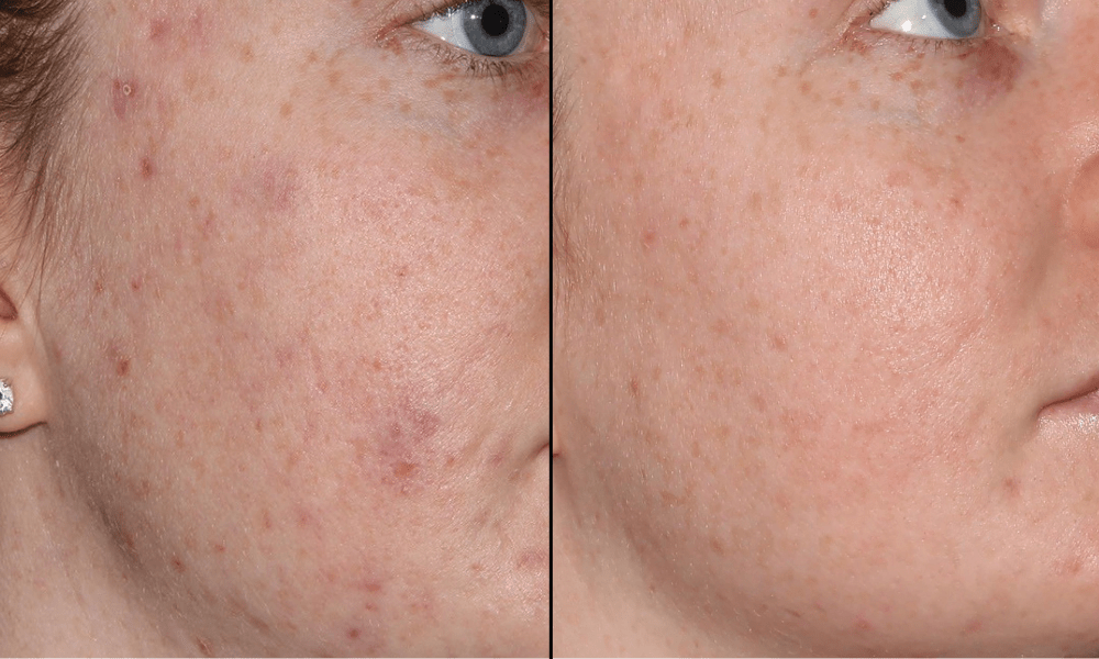 Forever-Clear-B&A-min