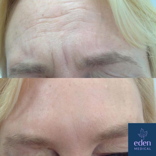 Anti-wrinkle injections forehead before and after