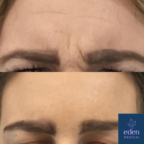 Anti-wrinkle injections frownlines before and after