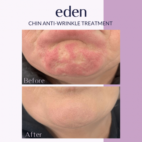 Before & After Chin Anti Wrinkle