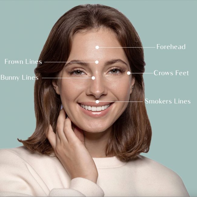 most common anti-wrinkle injection areas