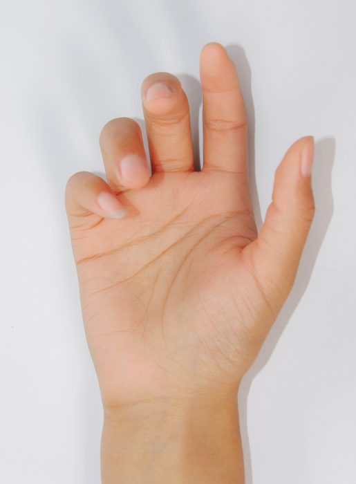 Hyperhidrosis Hand Treatment
