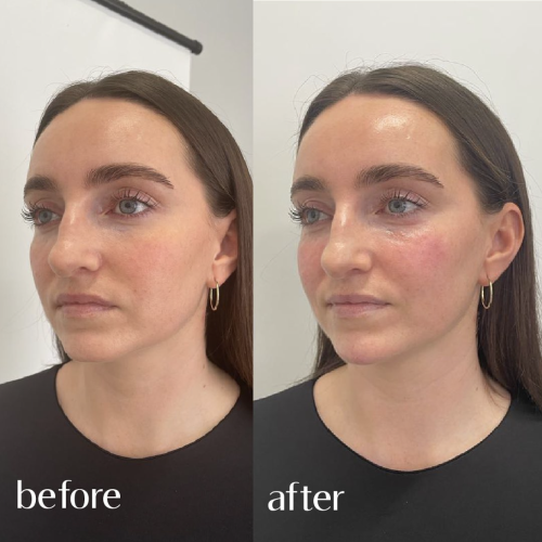 Chin filler before and after
