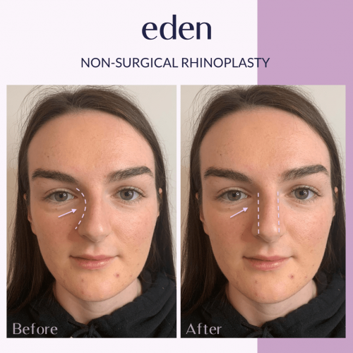 non-surgical rhinoplasty before and after