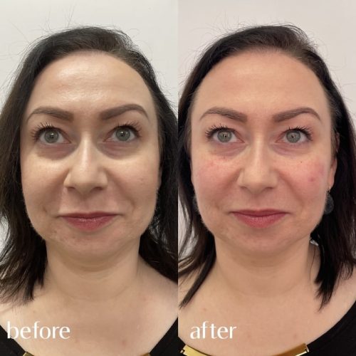 Tear Trough Filler Before and After