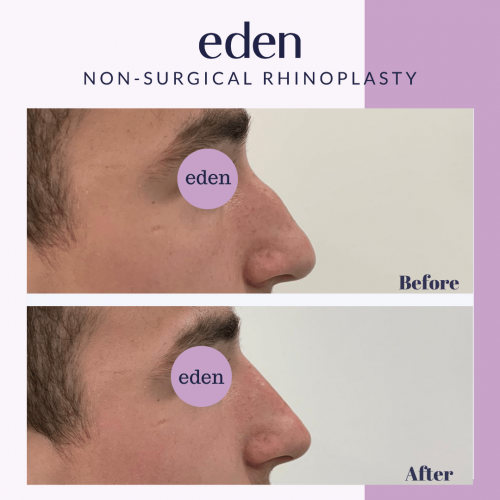 non-surgical rhinoplasty result